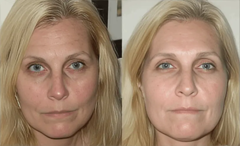 Botox Serum  Linda Parker, Plano, TX