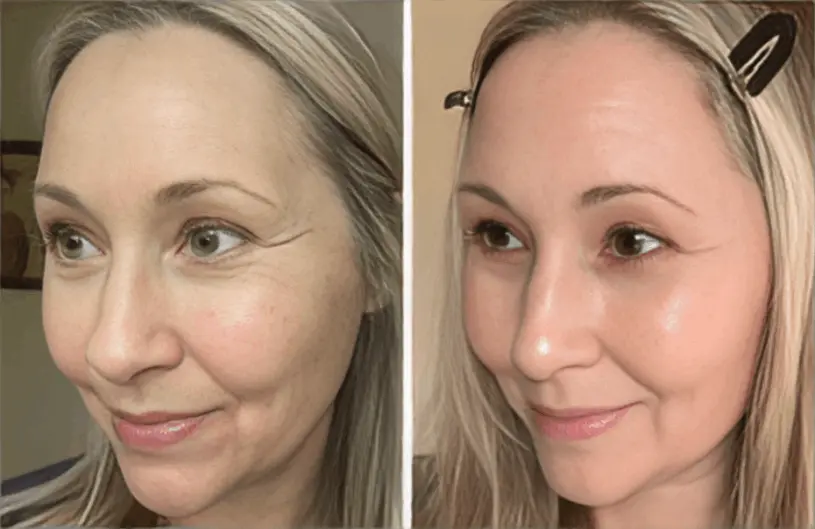 Botox Serum Marissa Evans,San Francisco, CA