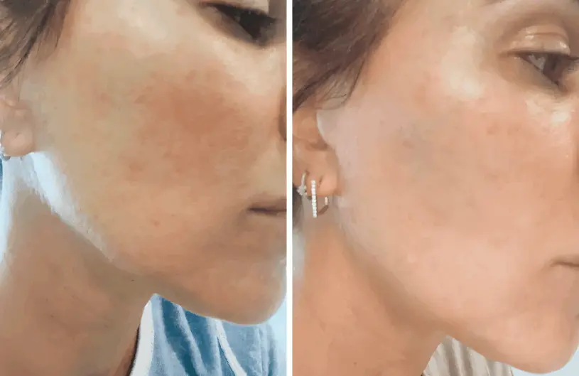 Botox Serum Cheryl Thompson, Chicago, IL 
